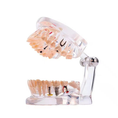 แบบจำลองฟัน 32 ซี่ พร้อมโรคฟันแบบเต็มเดือน สำหรับการปลูกรากฟันเทียม ดีไซน์ใส โมเดลพยาธิสภาพทางทันตกรรม